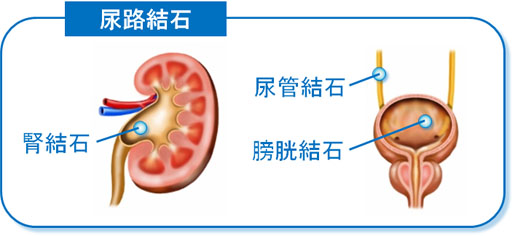 尿酸による尿路結石の生成